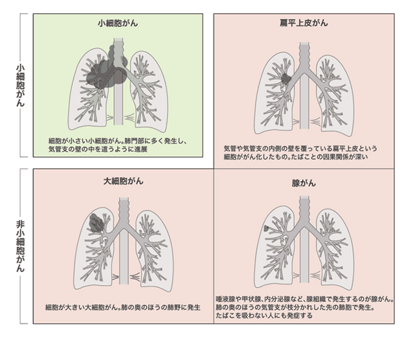 肺がん 病気について知る 人間ドック 健診会 東京メディカルクリニック